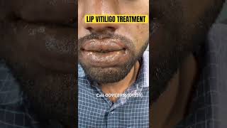 100 lip VITILIGO PERMANENT TREATMENT VITILIGO lip SAFED DAAG  lipvitiligotreatment shorts cure [upl. by Camellia]