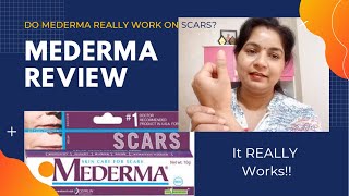 Mederma Cream Review for AcneBurn Scars and Stretch Marks [upl. by Enomad893]