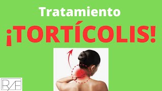 Tratamiento Tortícolis con quotAcupunturaquot [upl. by Neerroc]