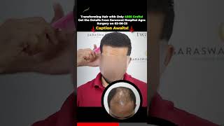 Hair Transplant Before and After  Hair Transplant Cost saraswathospital [upl. by Enilram]