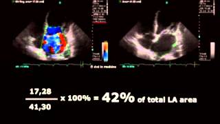 Volodymyr Pavliuk MD PhD Echocardiographic Assesment of Mitral Regurgitation [upl. by Niobe]