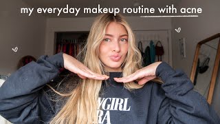 my everyday makeup routine with acne while on accutane [upl. by Eniarral]