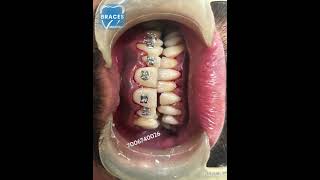 Class 2 div 1 Malocclusion  BRACES trending dentist toothdental dentalcare dentalclinic tooth [upl. by Erund111]