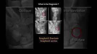 Scaphoid fracture  Scaphoid series 141Trauma Xray  Upper limb gallery 2radiologychannel007 [upl. by Dirk]