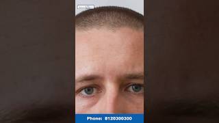 क्या Shave Head से बाल बढ़ते हैं  Does Shave Head Increase Hair Growth shorts viralvideo hair [upl. by Hussey]