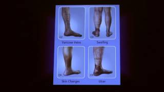 Treatment Options for Superficial Venous Disease  Cheryl Hoffman MD  UCLA Health [upl. by Miranda]