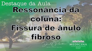 Fissura de ânulo fibroso e doença degenerativa discal na ressonância  Destaque da aula na USP [upl. by Declan]