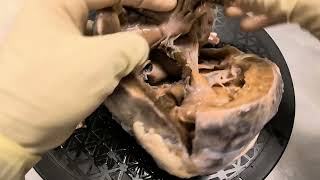 Specimen walkthrough 13 Double inlet double outlet right ventricle Cardiac anatomy pathology [upl. by Corly]