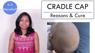 How to get rid of Cradle Cap in Babies Is it contagious [upl. by Nova]