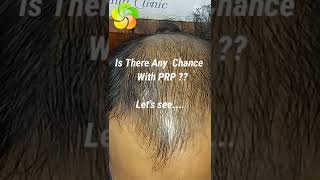 PRP Hair Loss Treatment Before and After  PRP Results [upl. by Hephzipah]