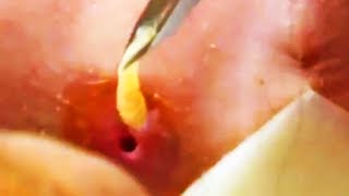 DISGUSTING BOT FLY REMOVAL  INSANE  NEW Video 2017 [upl. by Alliw]