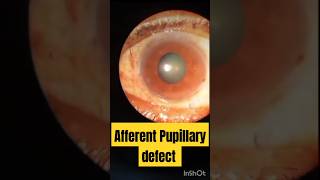 Afferent Pupillary Defect  APD pupilteacher eyediseases [upl. by Nalim7]