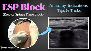 Erector Spinae Plane ESP Block [upl. by Mountford359]