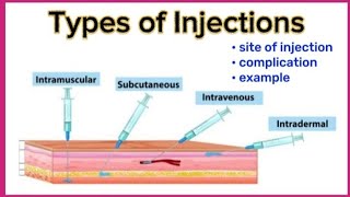 Types of injection and their site  Intravenous Intramuscular Intradermal Subcutaneous [upl. by Marjy424]