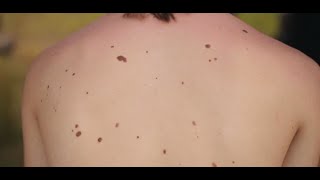 Dermatologist shares warning signs of melanoma [upl. by Wootan]