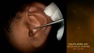 IMPACTED EAR WAX REMOVAL WITH HOOK HD [upl. by Mohamed]