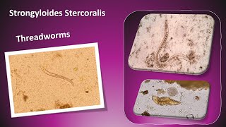 E3 parasitology Strongyloides stercoralis Parasitology [upl. by Nalak507]