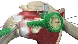 Biceptor Tenodesis System  Surgical Technique Walkthrough  SIMON MOYES [upl. by Elynad843]