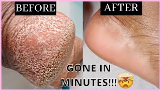 HOW TO REMOVE DEAD SKIN CELLS FROM YOUR FEET IN MINUTES  Self Care Routine [upl. by Olram]