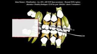 Orthodontie rapide  methodologie DAC en action [upl. by Barbabra]