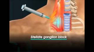 stellate ganglion block [upl. by Rainger]