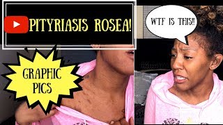 Vlog HORRIBLE RASH  Pityriasis Rosea  WHAT THE HELL [upl. by Corby]