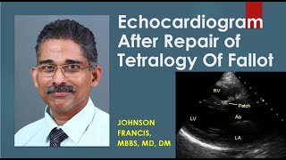 Echocardiogram After Repair of Tetralogy Of Fallot [upl. by Ennairda538]