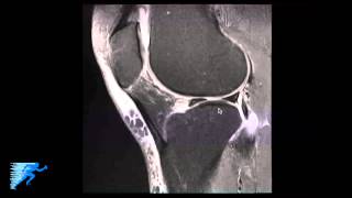 How to Read Knee MRI of Meniscal Root Tear  Knee Surgery Recovery Time  Minneapolis St Paul MN [upl. by Schaper]