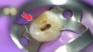 LIVE Root Canal Procedure under the Microscope w Specialist [upl. by Rafaj128]