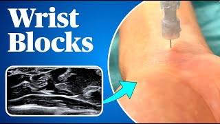 Wrist Blocks Landmark AND ultrasound guided approaches [upl. by Hock]