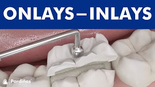 Dental inlays and onlays © [upl. by Nnylsaj]