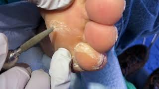 June clinic toenails calluses and corns continue [upl. by Cherin236]