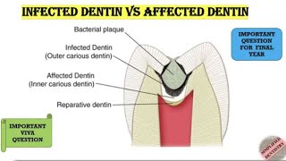 Quick Revision of Infected and Affected dentin dental dentistry bds [upl. by Yrrehc]