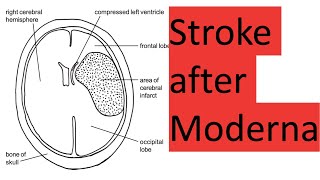 Stroke and death after Moderna [upl. by Anissa292]