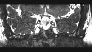 Craniopharyngioma adamantinomatous [upl. by Weiman]