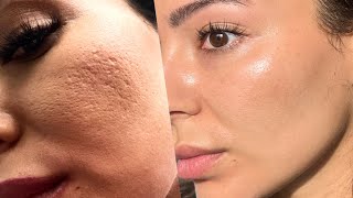 How I Got Rid of My Acne Scars and Large Open Pores [upl. by Irwinn]