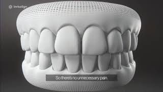 How Invisalign Works [upl. by Enyedy]