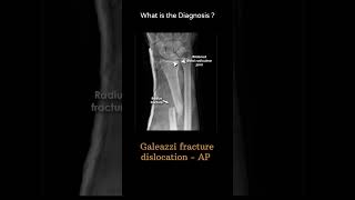 Galeazzi fracturedislocation  AP 126 Trauma Xray  Upper limb gallery 1 radiologychannel007 [upl. by Attemaj]