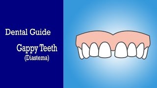 What is a Diastema  BOH Dental Guide to Gapped Teeth [upl. by Leummas]