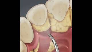 How teeth are cleaned at the dentist dentist dentalcare oralhygiene smile mouthwash [upl. by Schafer427]