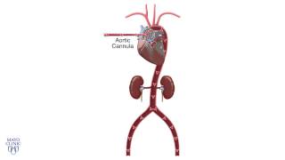 Central Cannulation and VenoArterial ECMO  Mayo Clinic [upl. by Lamok]