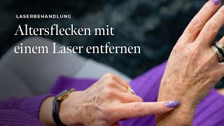 Altersflecken mit einem Laser entfernen  skinmed  Dermatologie in Lenzburg Aargau [upl. by Iliam]