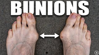 Bunions  Hallux Valgus Diagnosis Exercises Treatment [upl. by Lenod763]