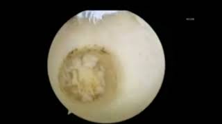 All Arthroscopic Osteochondral Autograft Transplantation for Medial Talar Dome Lesions Talus [upl. by Yaya]