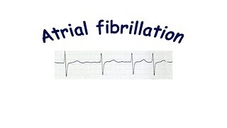 Atrial fibrillation [upl. by Adrien]