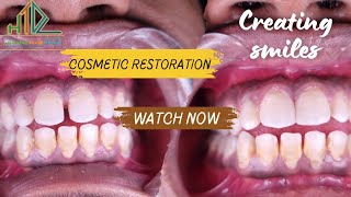 Dental Bonding Front Teeth  Cosmetic Restoration [upl. by Woolcott]