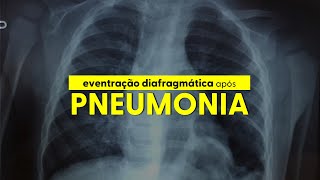 Eventração diafragmática pós pneumonia [upl. by Dyke]