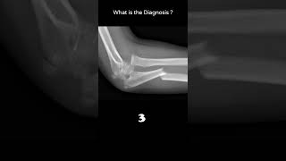 Monteggia fracturedislocation Lateral 125 Trauma Xray Upper limb gallery1radiologychannel007 [upl. by Manson]