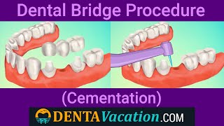 Dental Bridge Procedure Step By Step [upl. by Spring139]