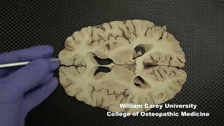 Horizontal slices of human forebrain neuroanatomy forebrain internal capsule caudate nucleus [upl. by Claude854]